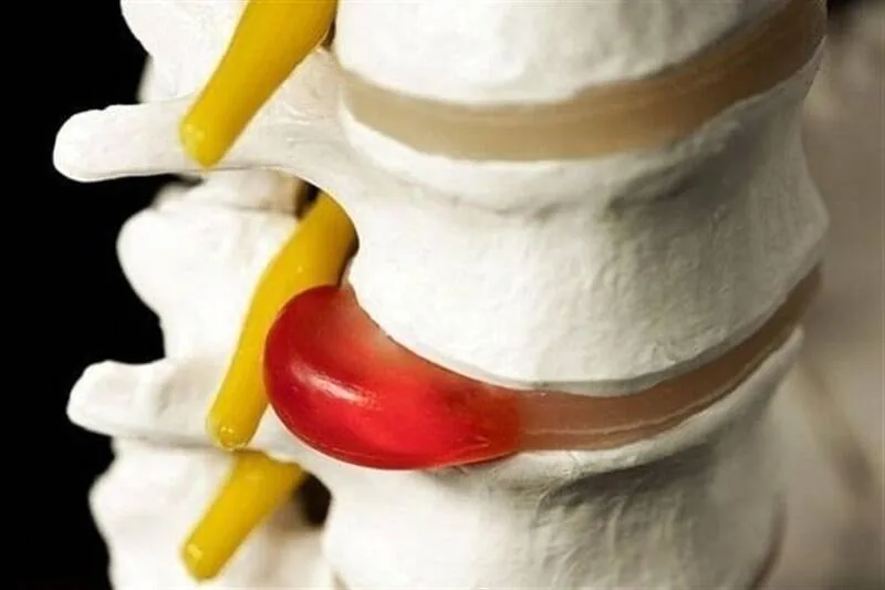 دیسک کمر همیشه به جراحی ختم نمیشود