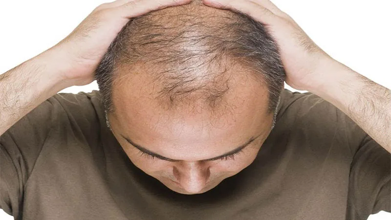 ریزش مو؛ از علت‌ها تا راهکارهای درمانی