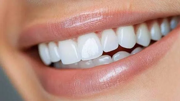 لمینت سرامیکی چگونه ساخته میشود و چه مزایایی دارد؟