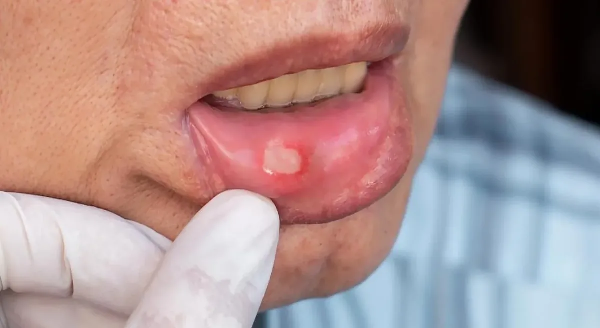 5 روش برای کاهش درد و کمک به بهبود آفت دهان