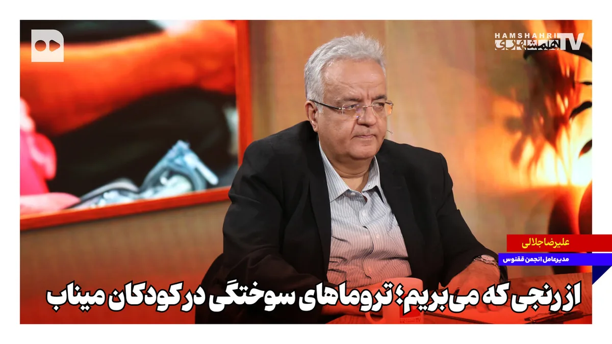 از رنجی که میبریم؛ تروماهای سوختگی در کودکان میناب