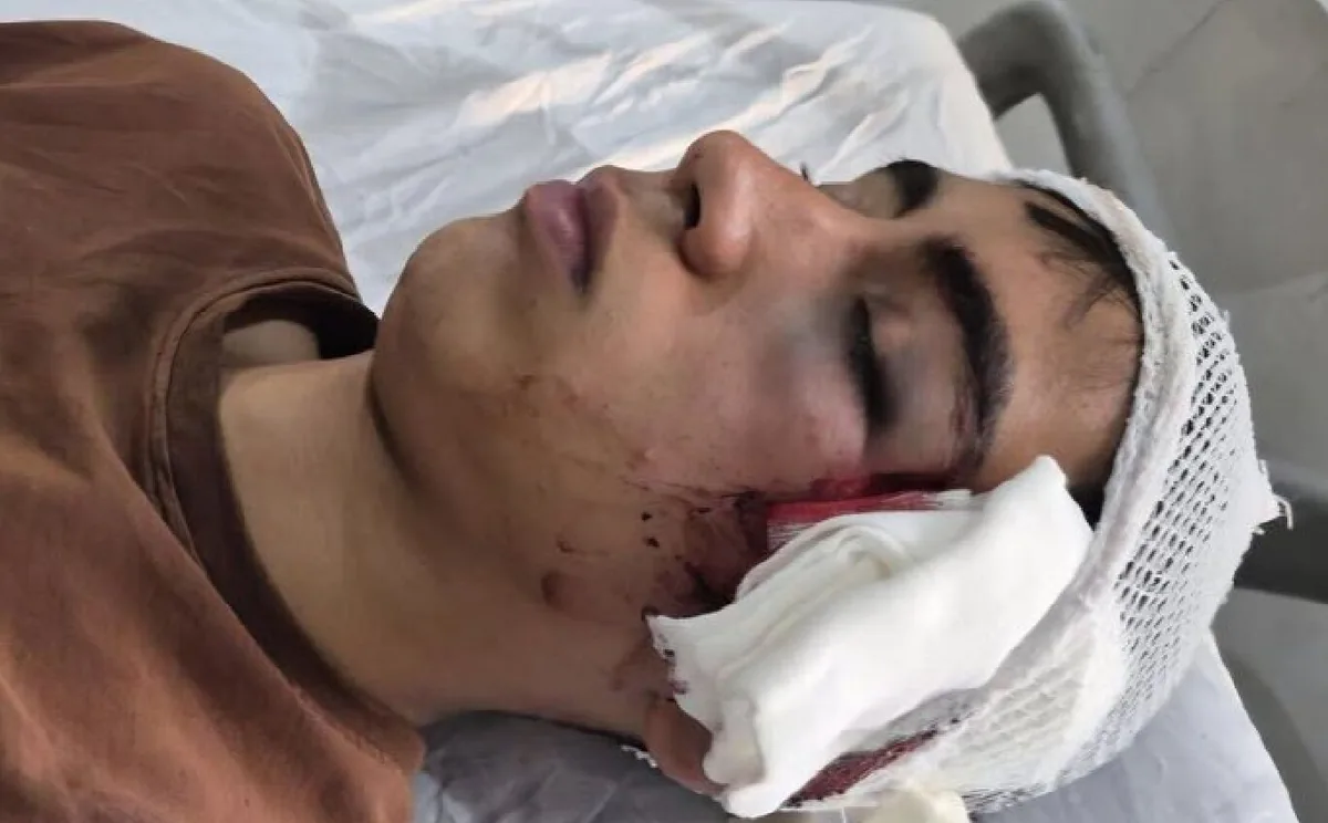 مصدومیت شدید دانشآموز توسط معلم در دهبکری بم/ معلم کلاس با دسته صندلی به این دانشآموز حملهور شد