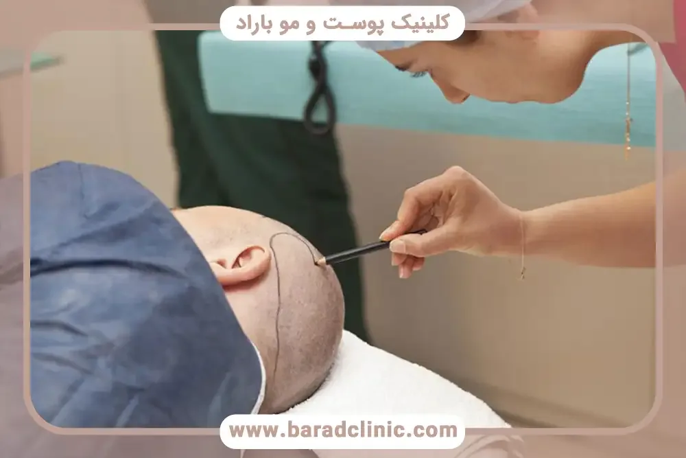 عوامل موثر در جراحی کاشت مو در کلینیک باراد