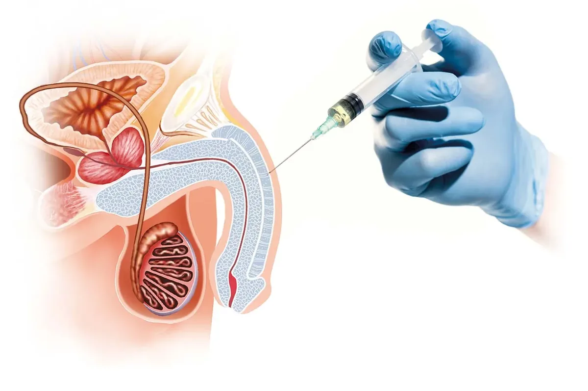prp نعوظ توسط دکتر ناطق