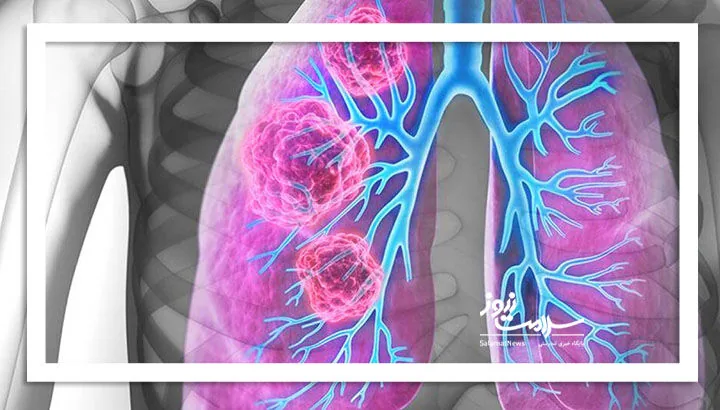 آمارهای قدیمی در برابر تهدیدی مرگبار؛ سرطان ریه در کمین ایرانیان