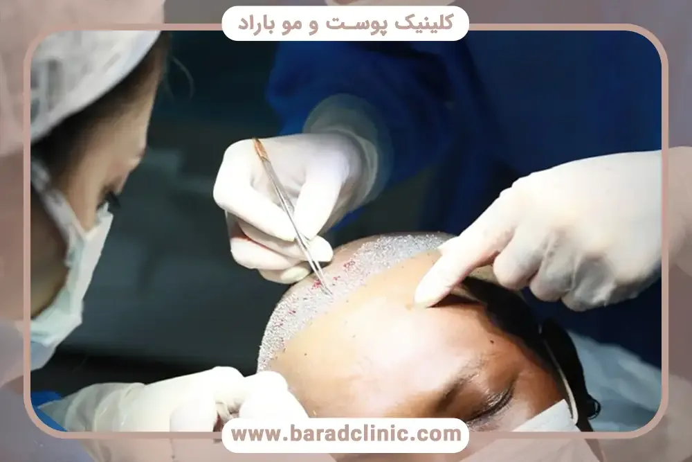 کاشت مو به روش تکثیری در کلینیک باراد تهران