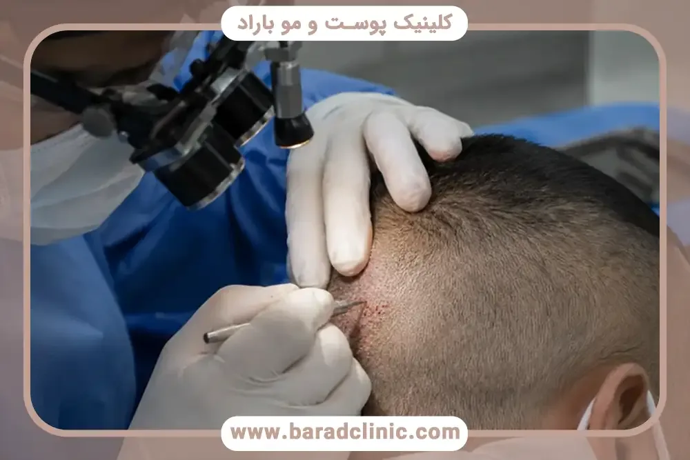 جراحی کاشت مو در کلینیک باراد چگونه انجام میشود