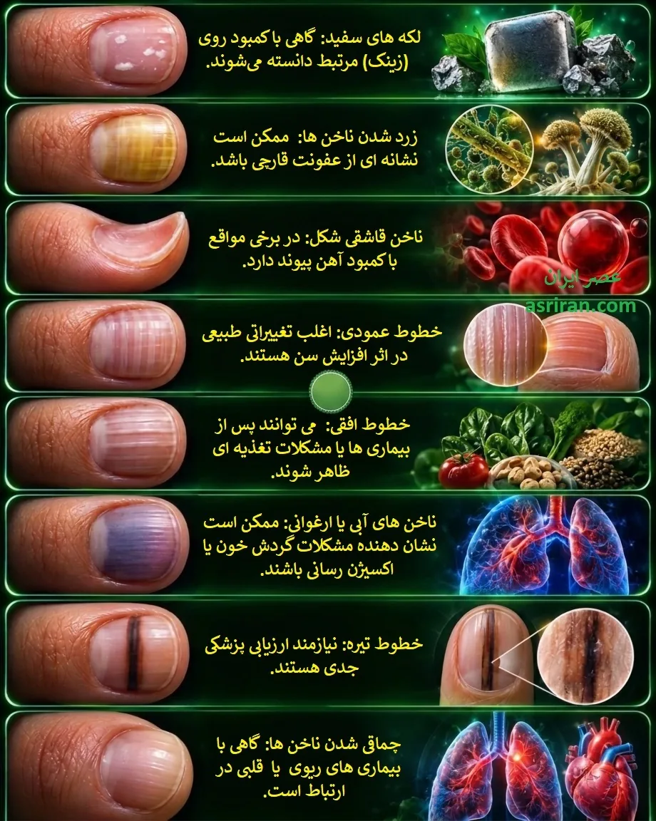 اینفوگرافیک تغییرات ناخن چه بیماری ها و کمبودهایی را لو می دهند؟