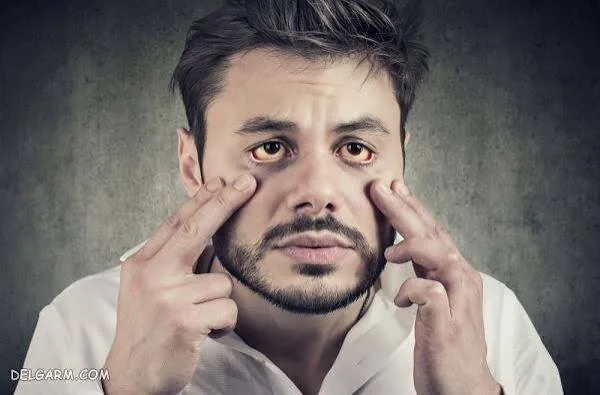 واقعا کمبود آهن را می‌توان از روی چهره تشخیص داد؟ نشانه‌هایی که باید جدی بگیرید