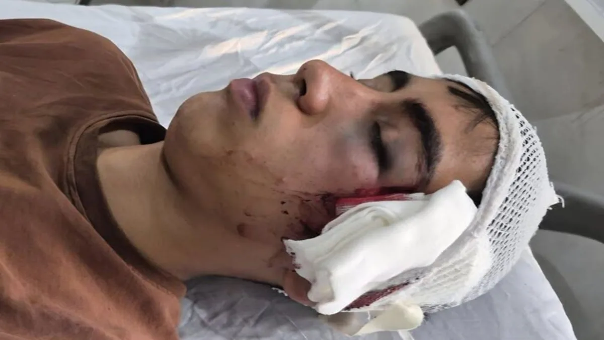 مصدومیت شدید دانشآموز توسط معلم در دهبکری بم