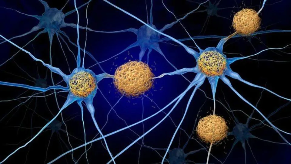 کشف راهی جدید برای مقابله با آلزایمر