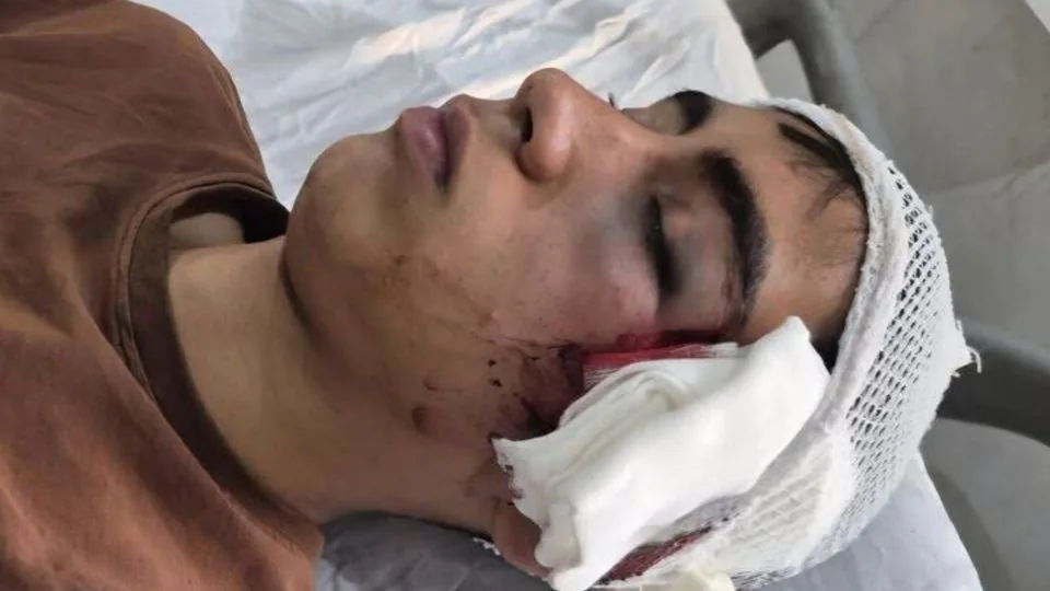 مصدومیت شدید دانشآموز توسط معلم در دهبکری بم